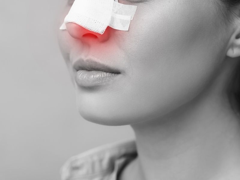 burun-ameliyati-sonrasi-odem