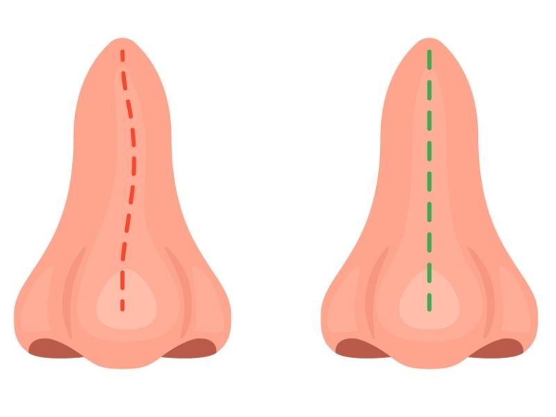 burun-egriligi-neden-olur