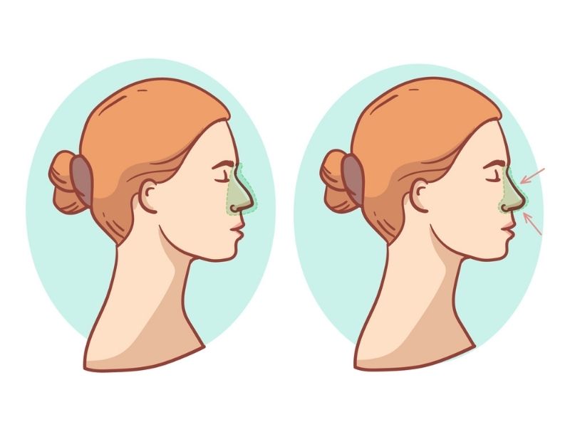 rinoplasti-sonrasi-kanama-miktari-ne-kadar-olmalidir