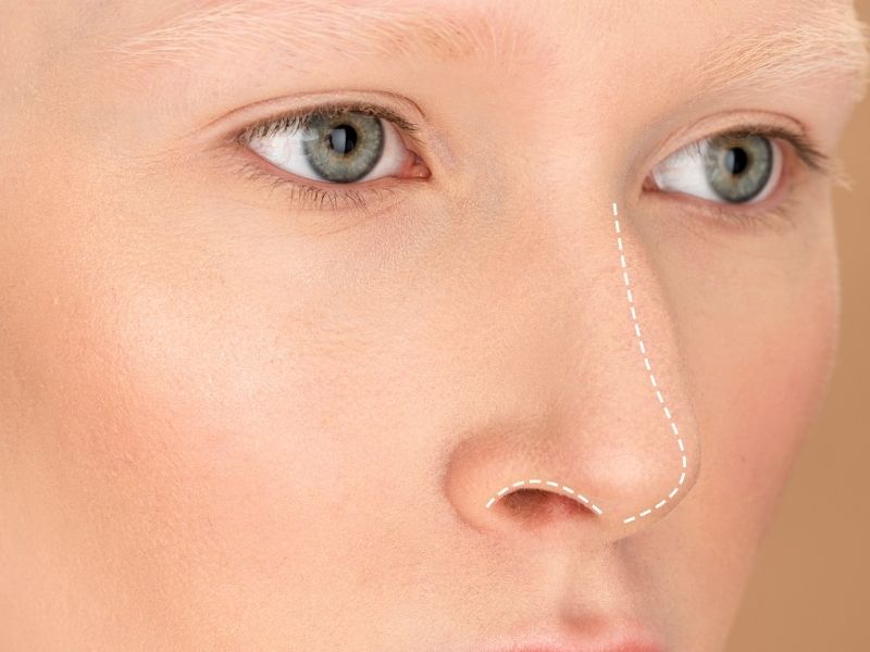 septorinoplasti-nedir