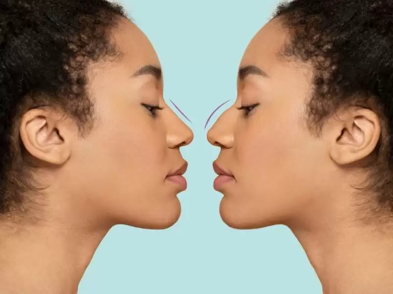 burun-estetiginde-dogal-burun-estetigi-ne-demektir