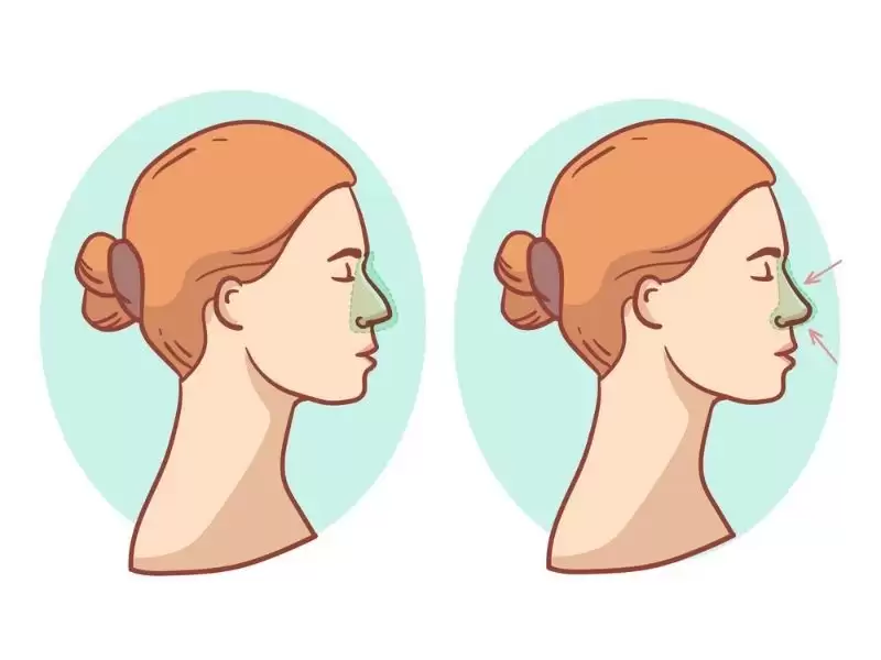 rinoplastide-acik-ve-kapali-teknik