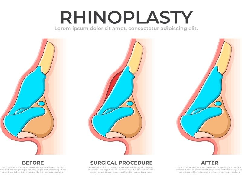 acik-rinoplastinin-avantajlari