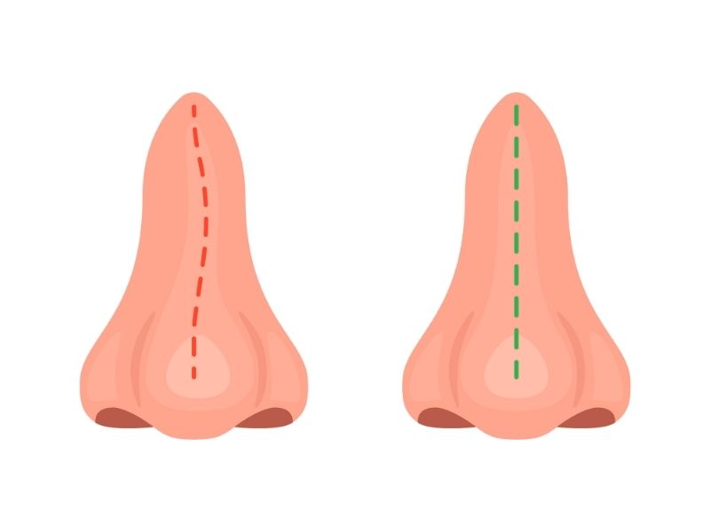 ameliyat-sonrasi-donemde-asimetri-normal-mi