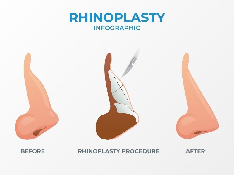 daha-duzgun-burun-sirti-isik-cizgisi