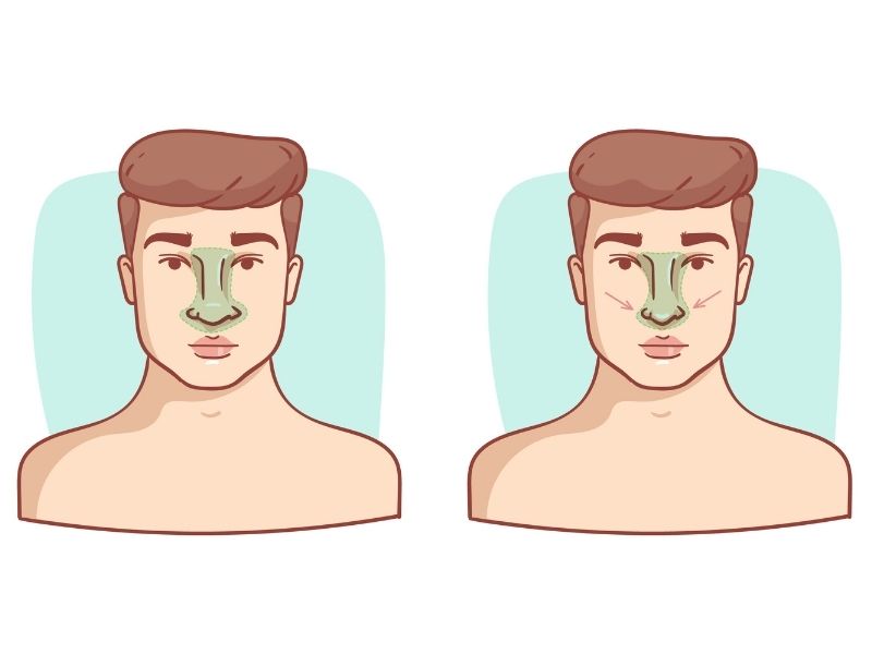 erkeklerde-rinoplasti-icin-alt-yas-siniri-nedir