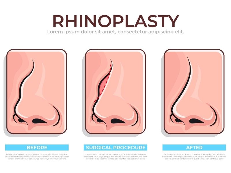 septum-deviasyonu-duzeltilmezse-ne-olur