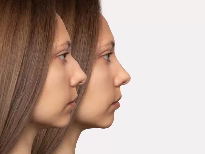 avrupai-burun-european-nose-nedir