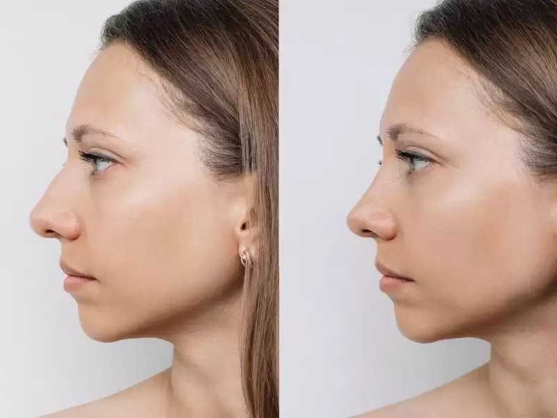 burun-estetik-ameliyati-rinoplasti-sonrasi