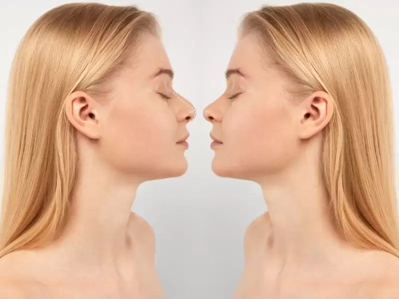 dusuk-burun-ucu-droopy-tip-nedir