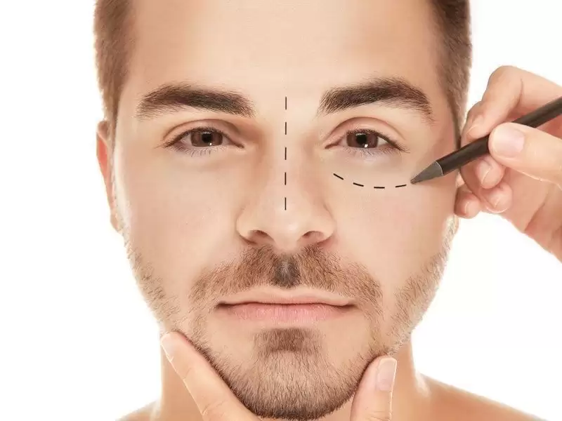 erkeklerde-burun-estetigi-rinoplasti-nasil-yapilir