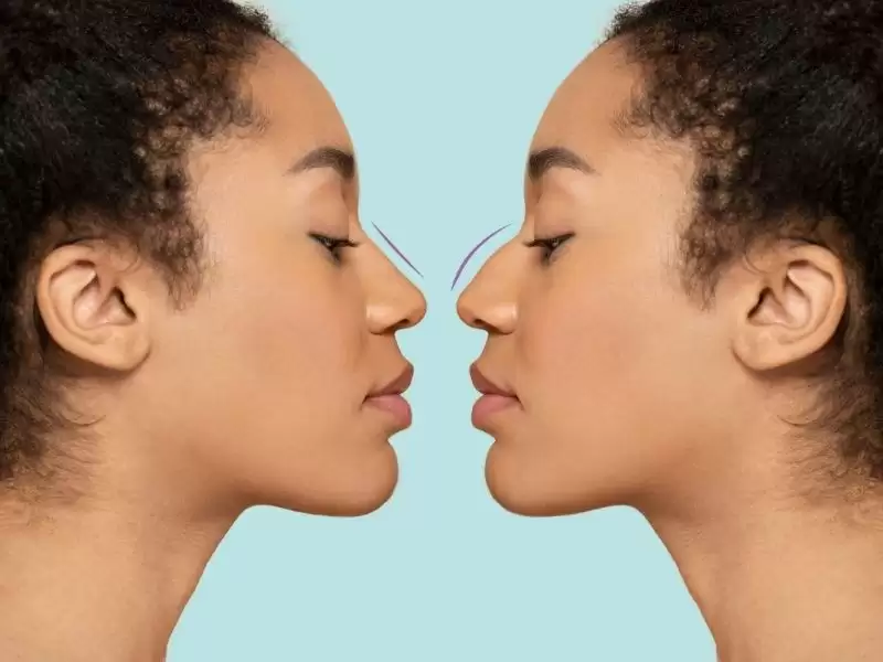 ileri-revizyon-rinoplastide-acik-mi-kapali-mi