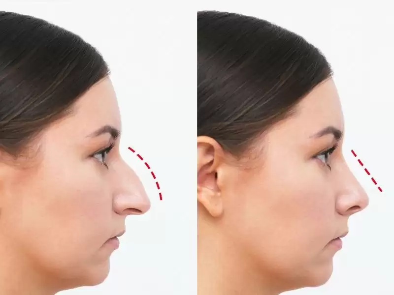 istanbul-da-piezo-rinoplasti-yaygin-mi