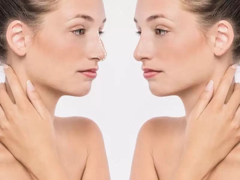 piezo-rinoplasti-avantajlari