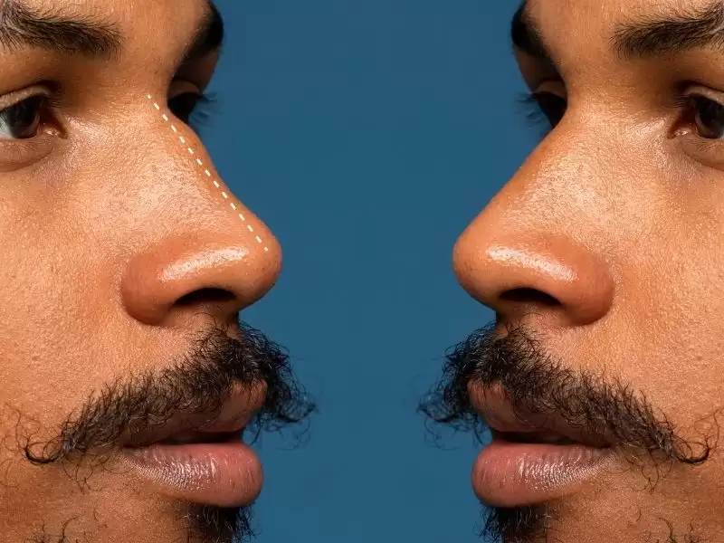 piezo-ultrasonik-rinoplasti-nedir