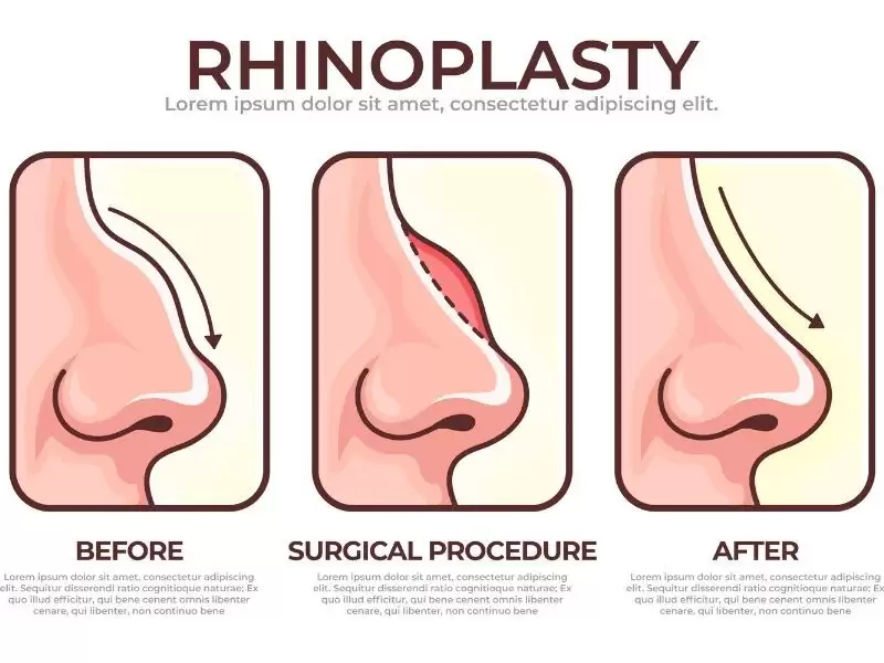 rinoplasti-burun-estetigi-ameliyati-oncesi-muayene-on-gorusme-degerlendirme-ucretleri