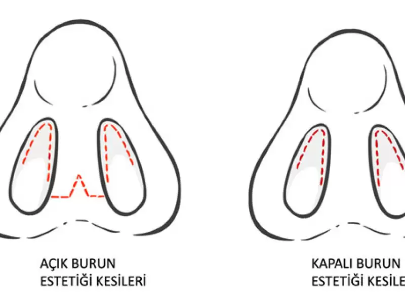 rinoplasti-burun-estetigi-doktoru