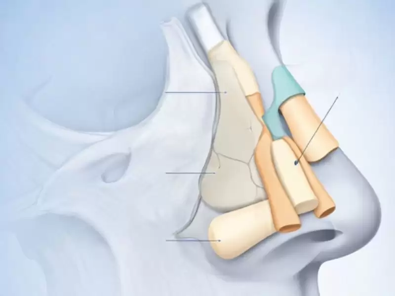 ileri-revizyon-rinoplasti-de-kikirdak-greft-kullanimi