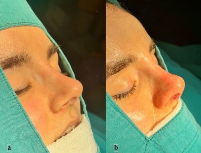 burun-ucu-ameliyati-sonuc