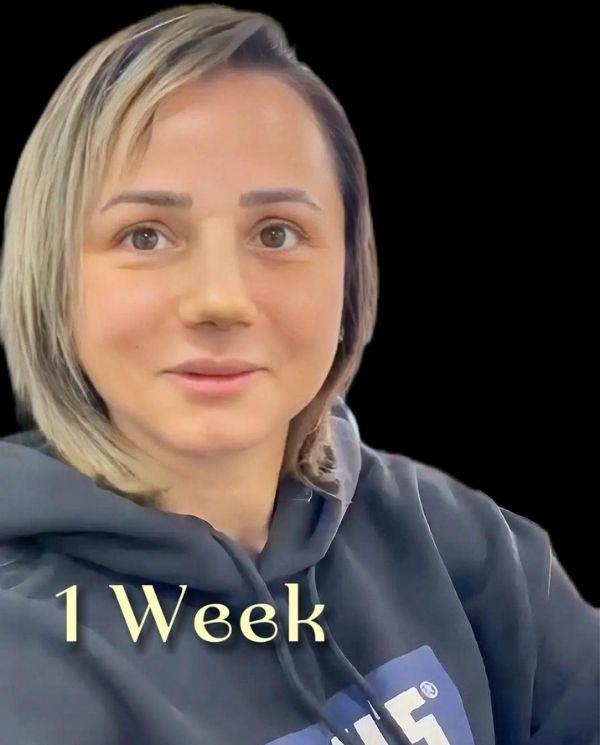 1-month-after-rhinoplasty