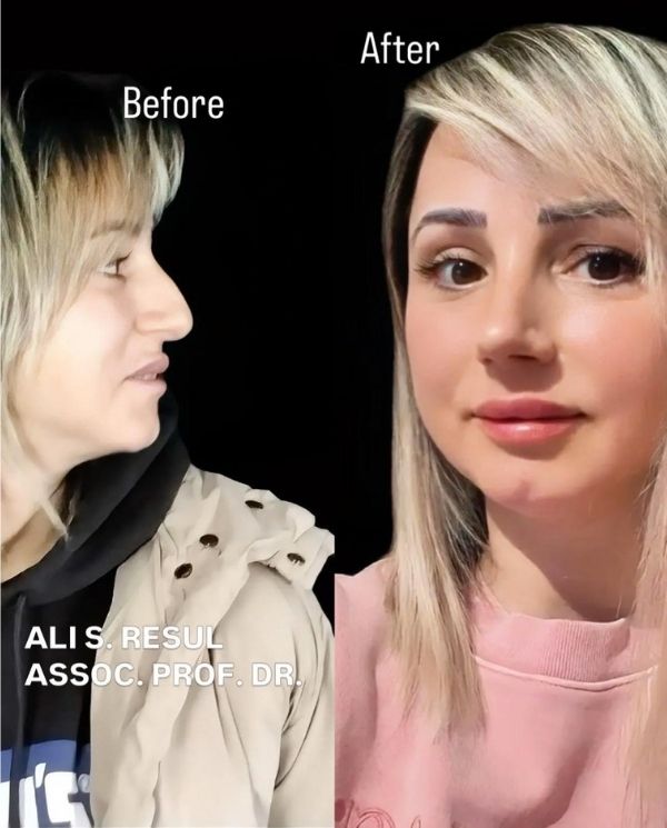 patient-reviews-after-rhinoplasty