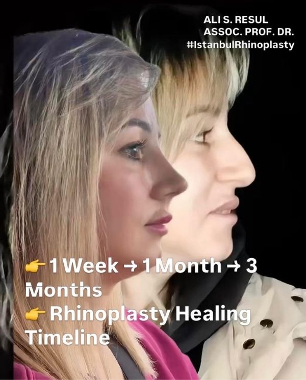 first-week-after-rhinoplasty