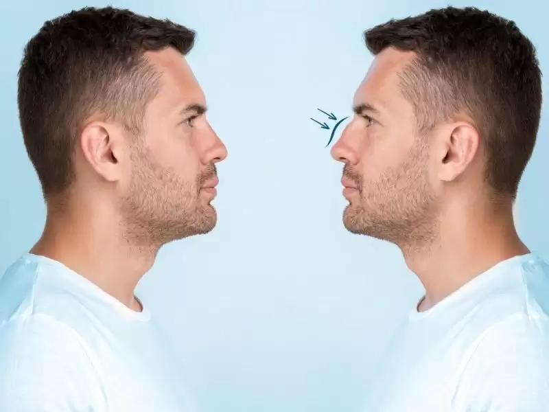 erkek-burun-estetigi