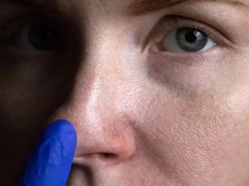 revizyon-rinoplastide-burun-ucu-projeksiyonunu-azaltmak-icin-yeni-bir-teknik