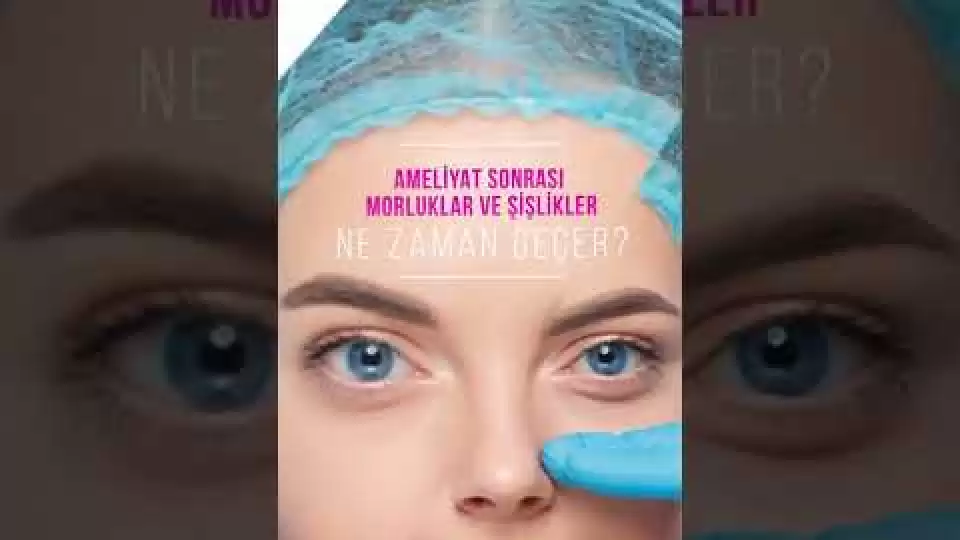 Rinoplasti,Burun Estetiği