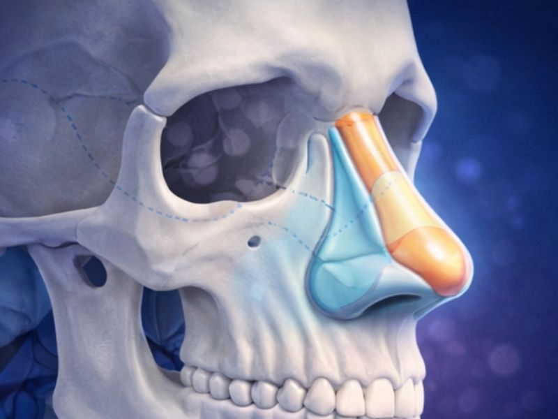 closed-rhinoplasty-technique